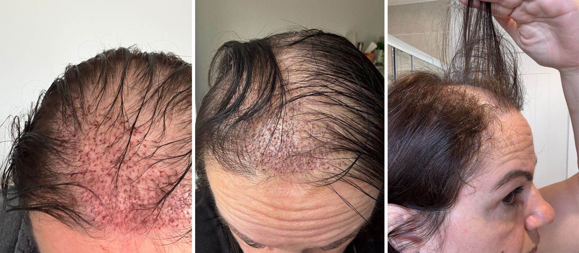 خضعت إيفانز لعملية زراعة شعر في عام 2024 ولكنّها لم تنجح.