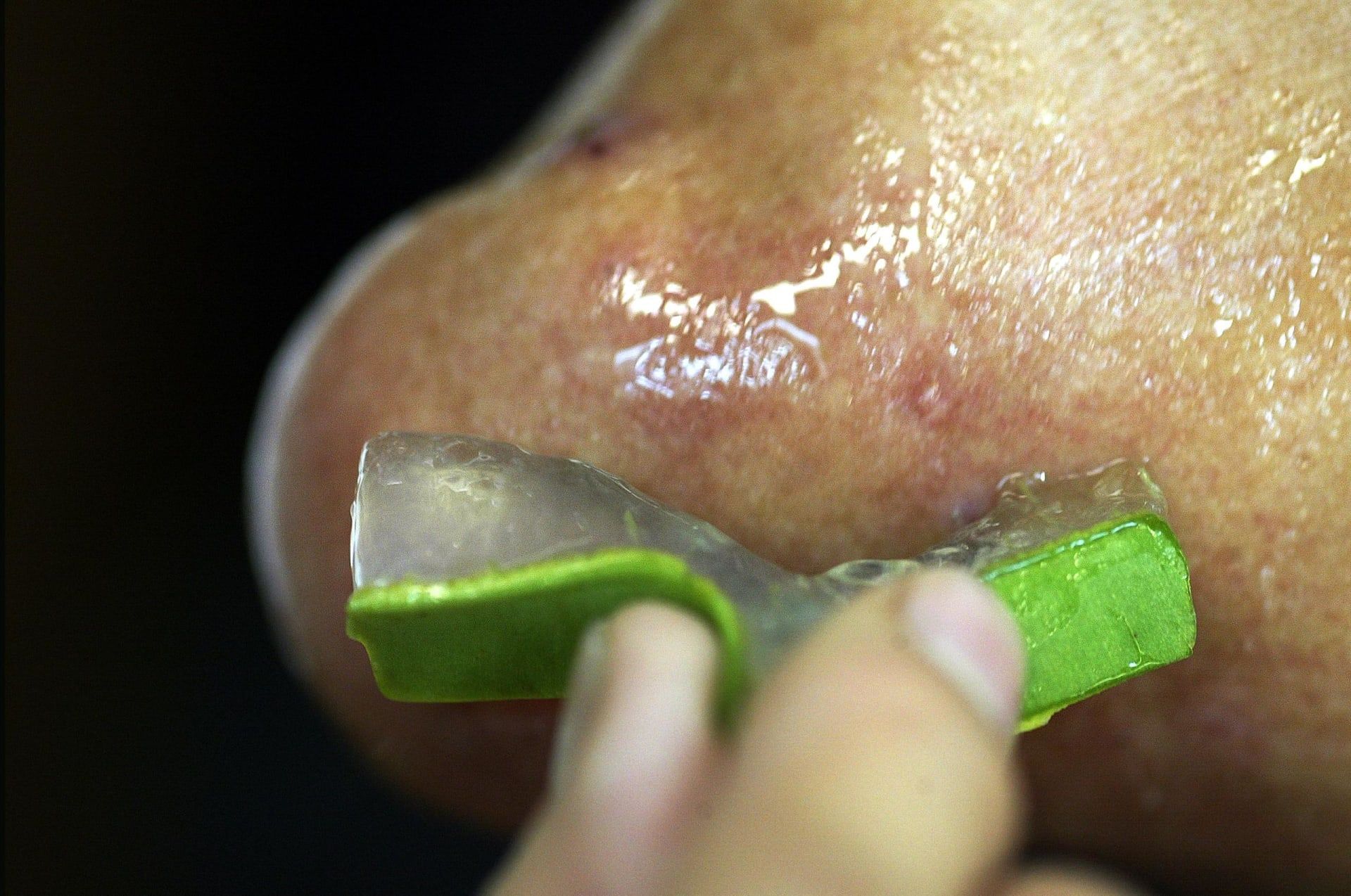 يمكن لجل الألوفيرا أن يكون علاجًا موضعيًا لعدد من مشاكل البشرة، أبرزها الحروق من أشعّة الشمس.