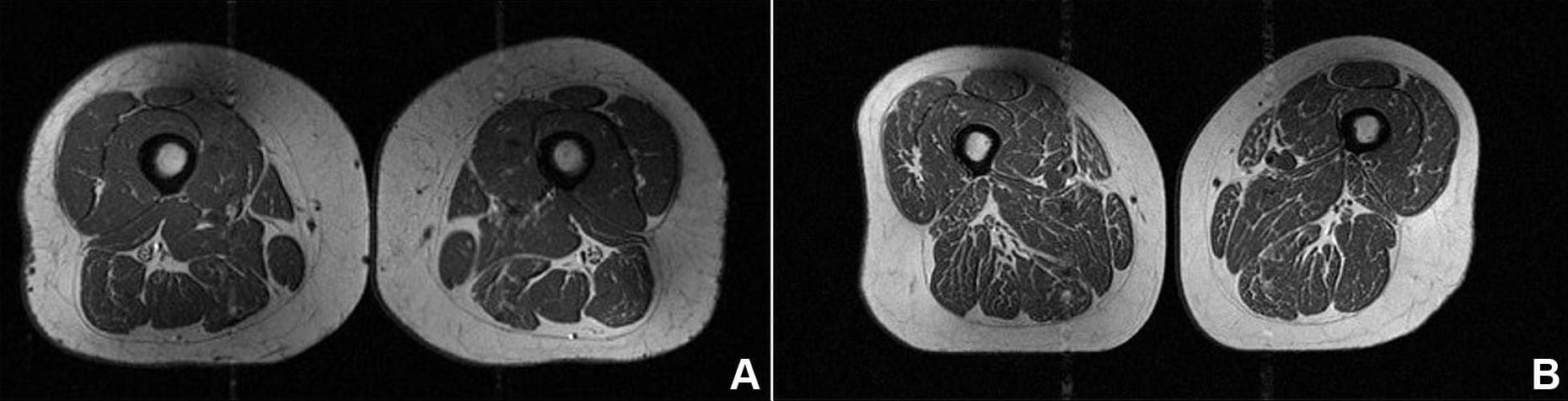 هذه الصورة لا تُظهر شريحة لحم.. هكذا تدمر الأطعمة فائقة المعالجة جودة عضلاتك