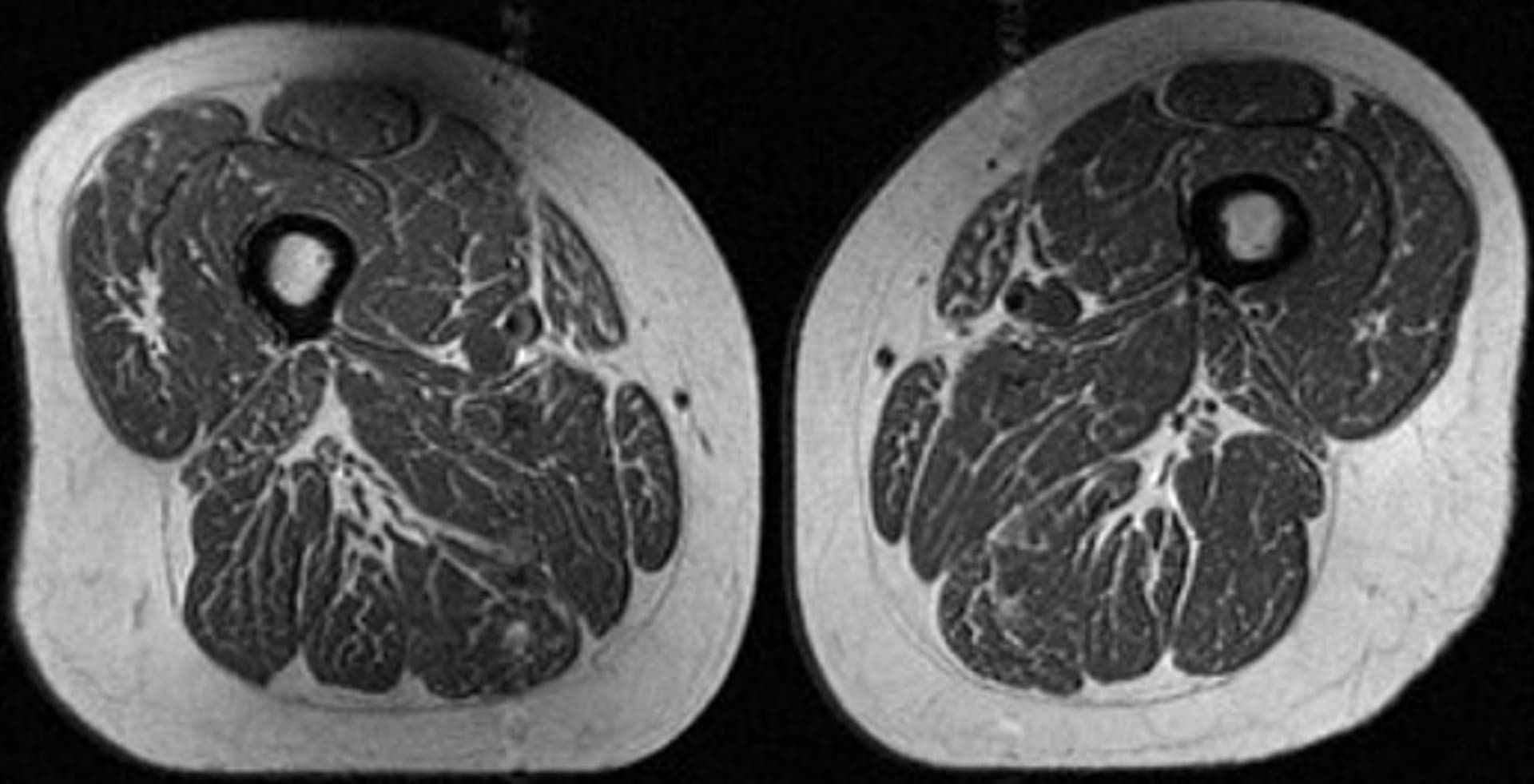 بسبب الأطعمة فائقة المعالجة.. أفخاذ البشر أصبحت تبدو كشرائح لحم مليئة بالدهون