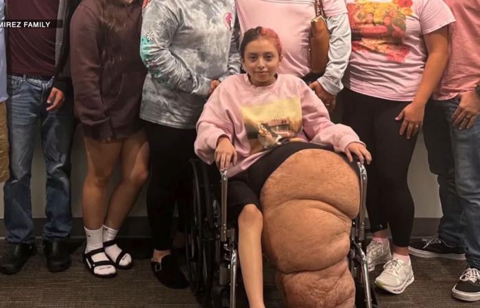 تجاوز وزنها 70 كيلوغرامًا.. مراهقة تعاني من حالة نادرة انتهت ببتر ساقها