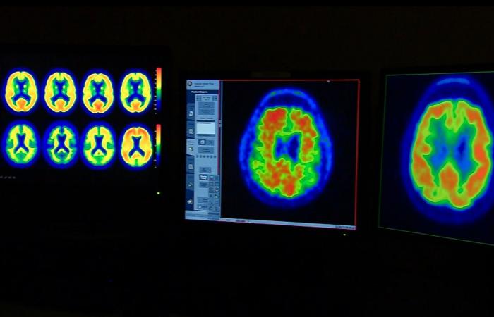 إرشادات جديدة لعلاج إصابات الدماغ.. إليك ما ينبغي معرفته